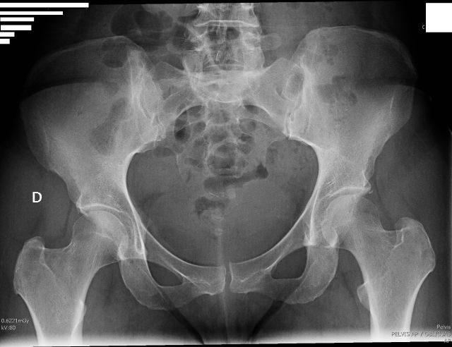 AP Pelvis Positioning